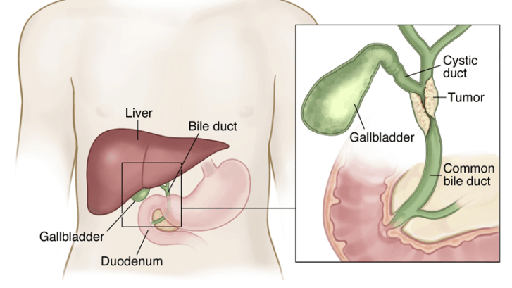 bileductcancer-727x409-1.png