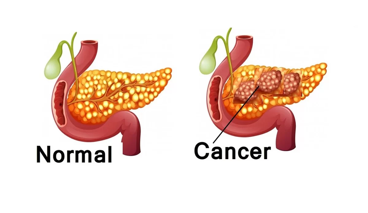 Pancreatic-Cancer.png