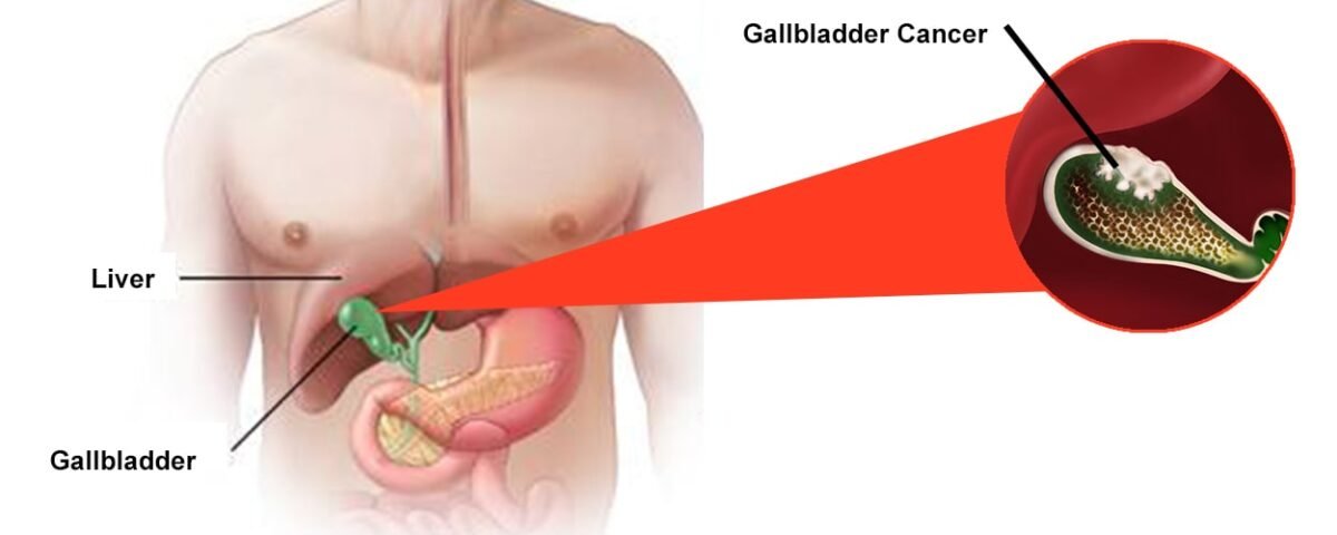Gallbladder-cancer-min-1200x480.jpg