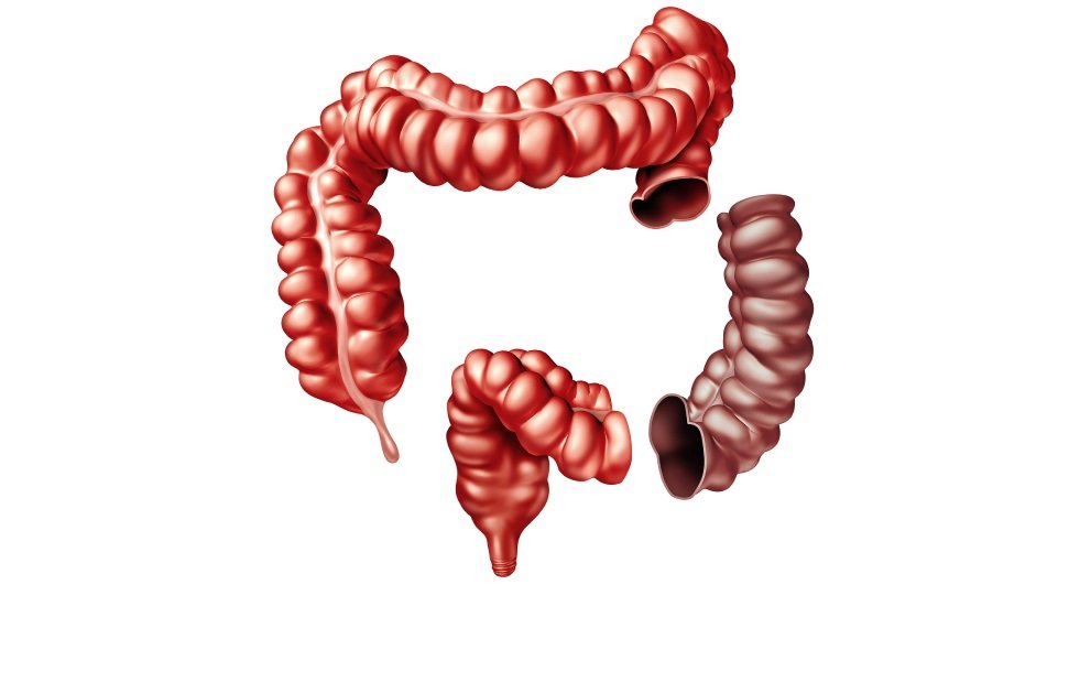 Colectomy.jpg