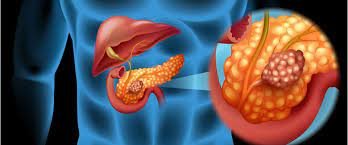 pancreatic-cancer.jpeg