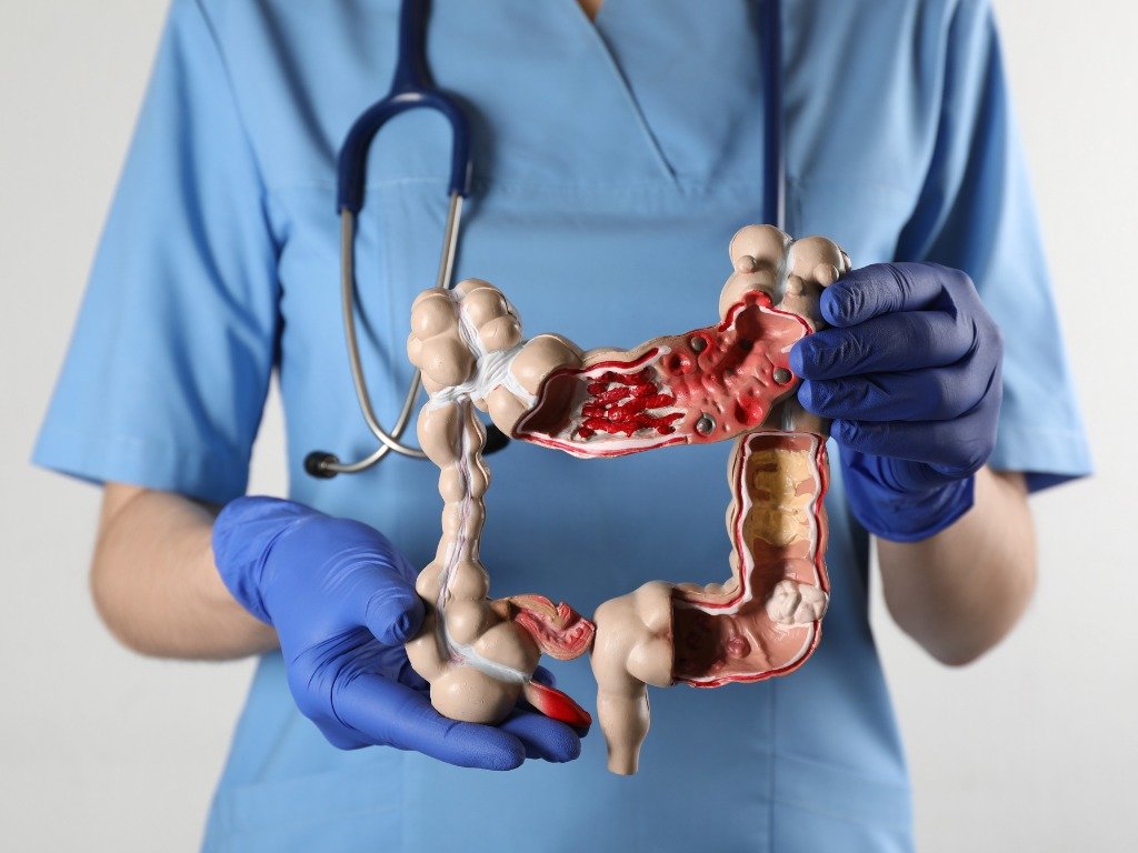 Colon Cancer Surgery in Delhi