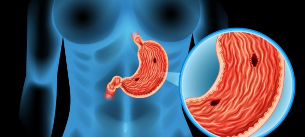 what-are-stomach-cancer-symptoms.jpg