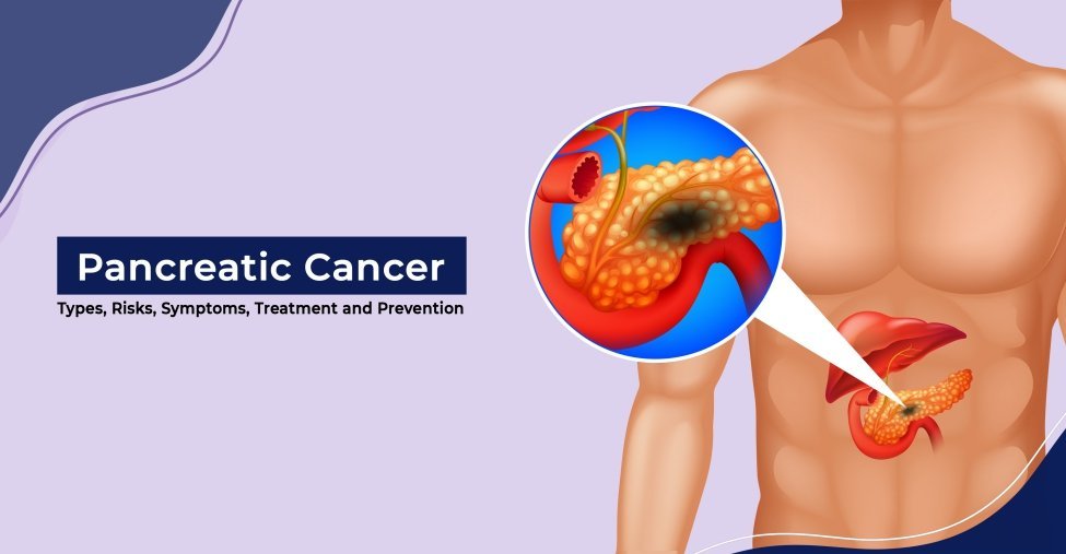 What Are the Different Surgical Options for Pancreatic Cancer?