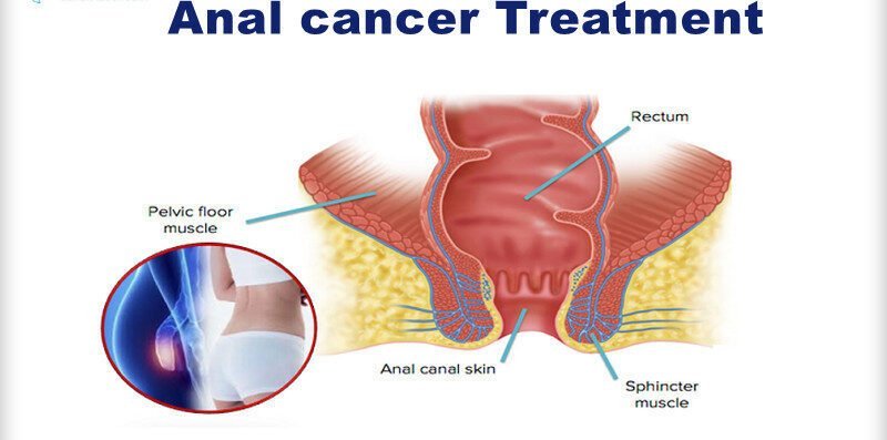 What Are the Key Dietary Guidelines for Anal Cancer Surgery Recovery?
