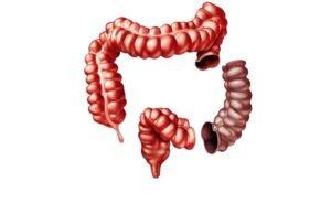 Is colectomy a major surgery? – Dr. Deep Goel
