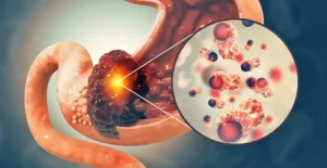 What Are the Latest Advancements in GI Cancer Treatment?