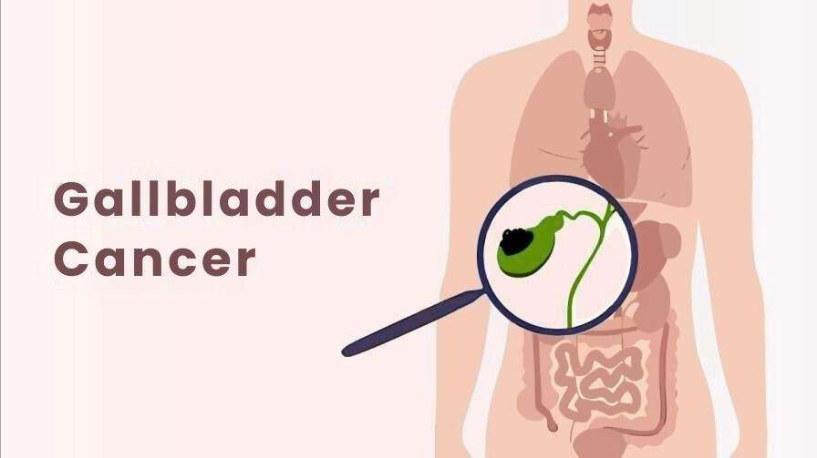 What is gallbladder cancer What is the best treatment for gallbladder cancer?
Can gallbladder cancer be cured?
Who is the best gallbladder cancer surgeon in Delhi?
What are the symptoms of gallbladder cancer?
How is gallbladder cancer diagnosed?
What is radical cholecystectomy?
Is surgery necessary for gallbladder cancer?
What is the success rate of gallbladder cancer surgery?
How long does gallbladder cancer surgery take?
How much does gallbladder cancer treatment cost in Delhi?
Is chemotherapy required after gallbladder cancer surgery?
What foods should I eat after gallbladder cancer surgery?
How long is recovery after gallbladder cancer surgery?
Can gallbladder cancer return after surgery?
How do I consult a gallbladder cancer specialist in Delhi?