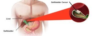 Nutrition and Diet After Gallbladder Cancer Surgery