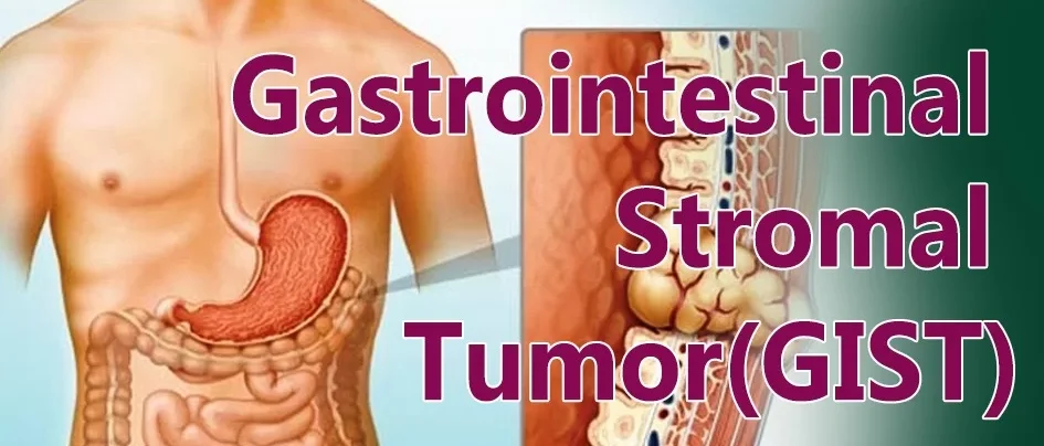 Is Gastrointestinal Stromal Tumor Surgery Right for You?