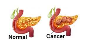 Is Pancreatic Cancer Curable If Detected Early?