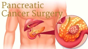 Is Pancreatic Cancer Surgery Painful? – Dr. Deep Goel