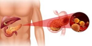 Understanding Treatment Options for Pancreatic Cancer – Dr. Deep Goel