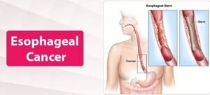 What are the Causes and Symptoms of Esophageal Cancer? – Dr. Deep Goel