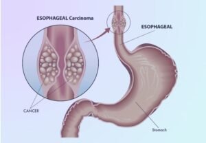 Can Early Detection Improve Esophageal Cancer Surgery Outcomes?