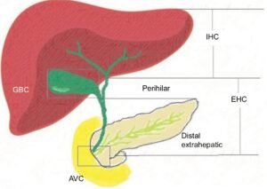 What are the Early Signs of Biliary Tract Cancer?