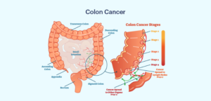 Colon Cancer Surgery: What You Need to Know?