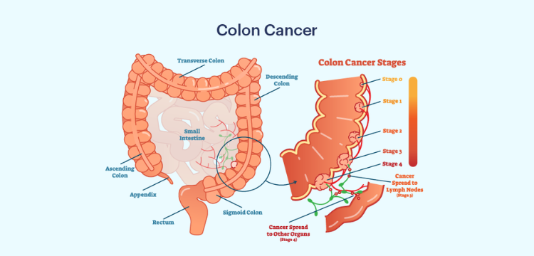 Colon Cancer Surgery: What You Need to Know?
