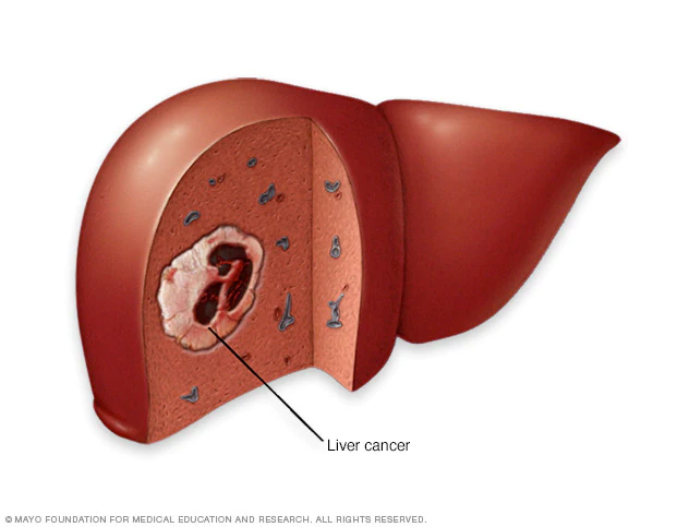 Hepatocellular Carcinoma: What Are Its Symptoms, Causes And Treatments?