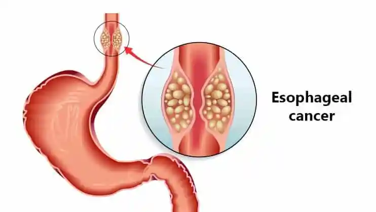 Can Lifestyle Changes Help Prevent Esophageal Cancer?