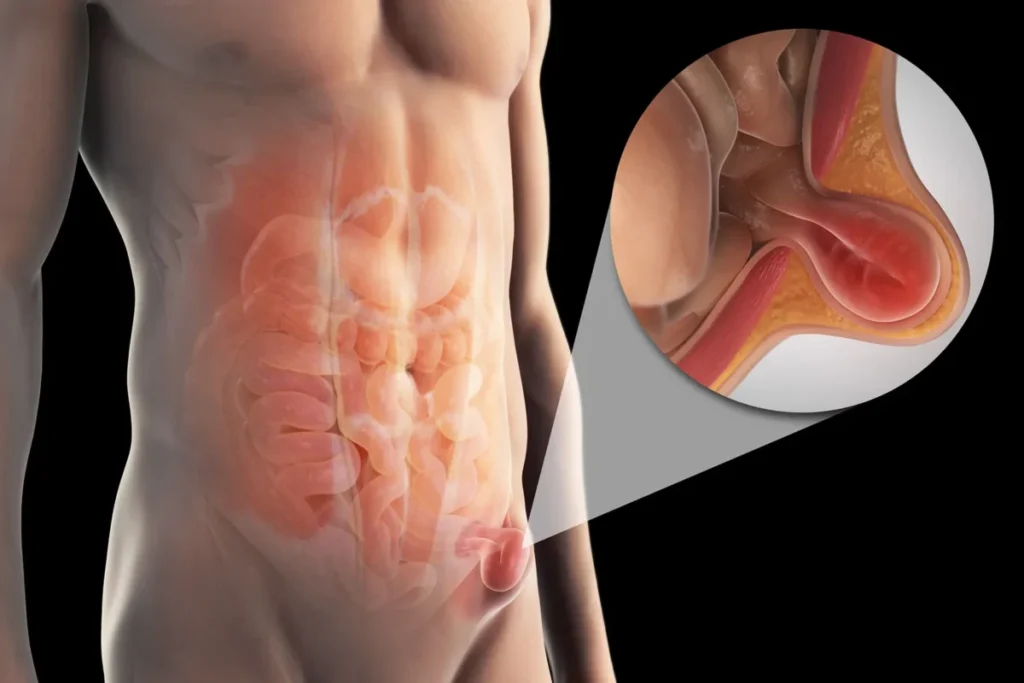 Hernia Symptoms You Shouldn’t Ignore: A Guide to Early Detection and Care