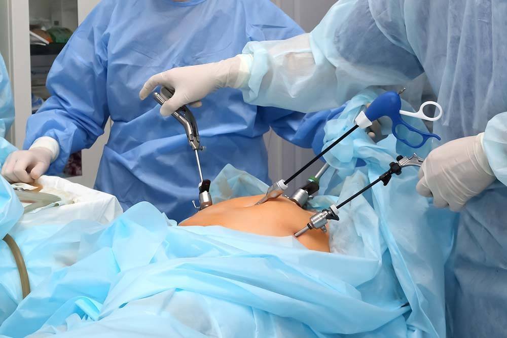 लेप्रोस्कोपिक सर्जरी (Laparoscopic Surgery) क्या है? फायदे, प्रक्रिया, खर्च और रिकवरी की पूरी जानकारी