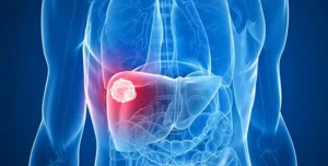 How to Prepare for Liver Cancer Surgery: A Comprehensive Guide