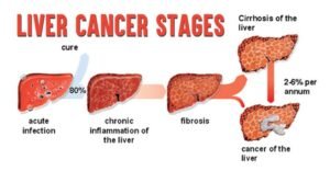 Can Early-Stage Liver Cancer Be Completely Cured?