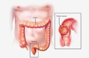 What Are Rectal Cancer Surgery Options?