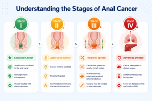 Stages of anal cancer infographic showing Stage I to Stage IV progression and treatment overview.