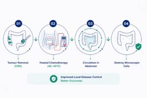 HIPEC surgery procedure infographic showing tumour removal, heated chemotherapy, abdominal circulation, and microscopic cell destruction