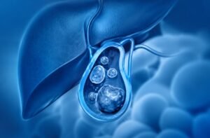 Gallstone Symptoms: What the Pain Is Really Telling You