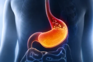 What Is GERD Surgery? (Types, Cost, Recovery & More)