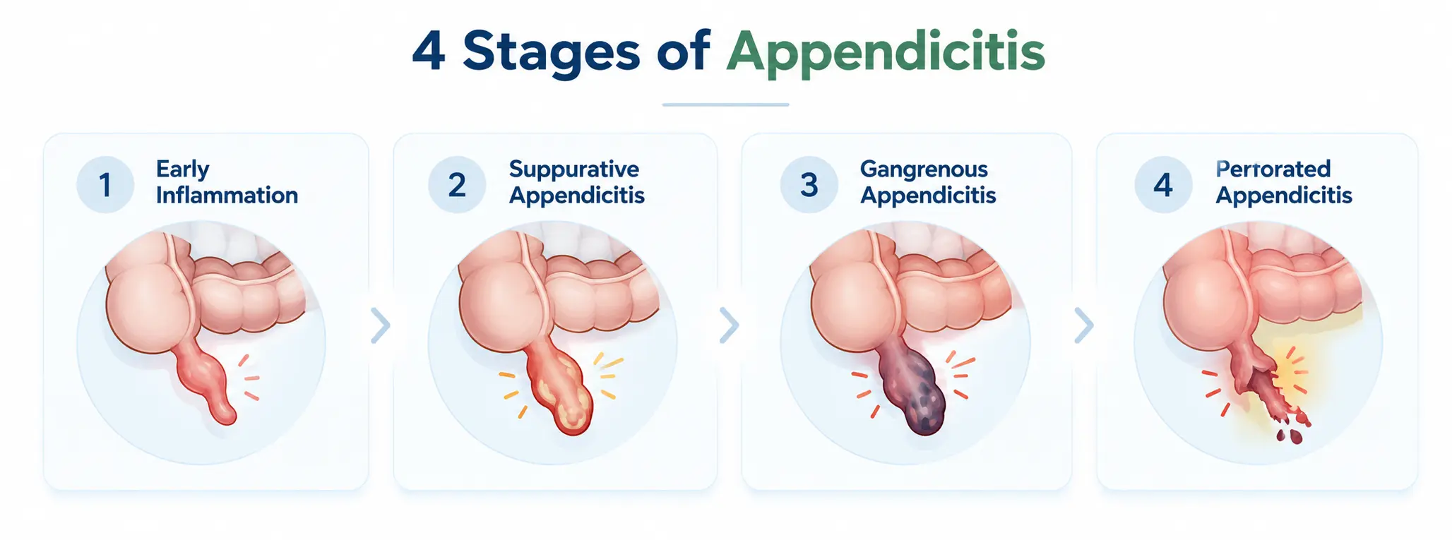appendicitis stages